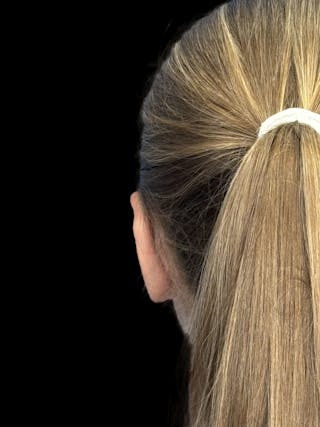 Otoplasty Before & After Gallery - Patient 346043 - Image 6