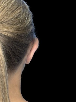 Otoplasty Before & After Gallery - Patient 346043 - Image 2