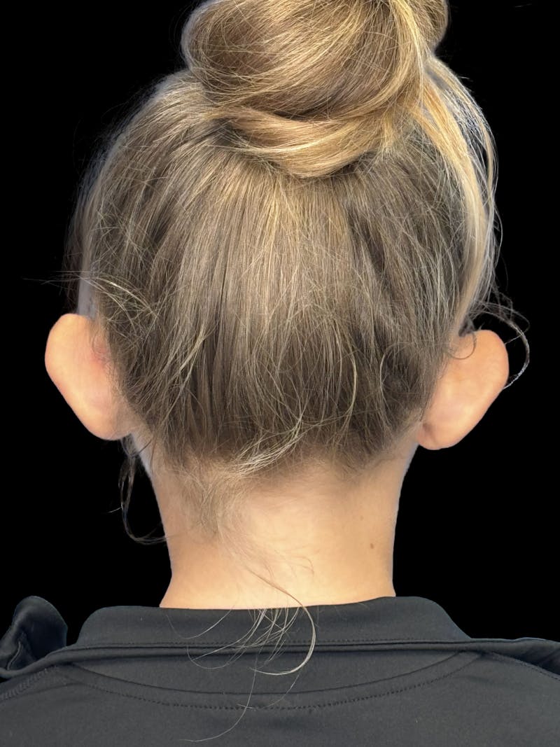 Otoplasty Before & After Gallery - Patient 346043 - Image 3