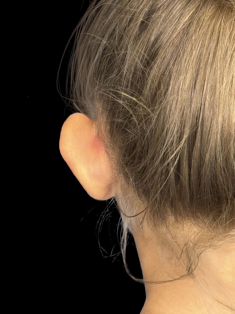 Otoplasty Before & After Gallery - Patient 346043 - Image 5