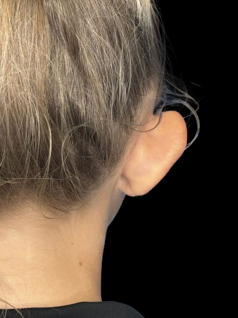 Otoplasty Before & After Gallery - Patient 346043 - Image 1