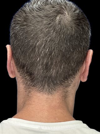 Otoplasty Before & After Gallery - Patient 215442 - Image 4