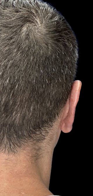 Otoplasty Before & After Gallery - Patient 215442 - Image 6