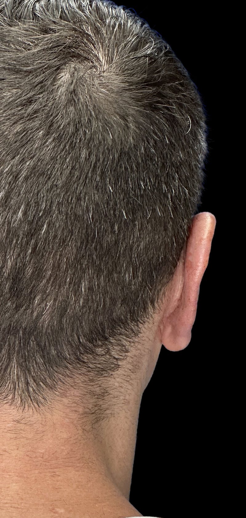 Otoplasty Before & After Gallery - Patient 215442 - Image 6