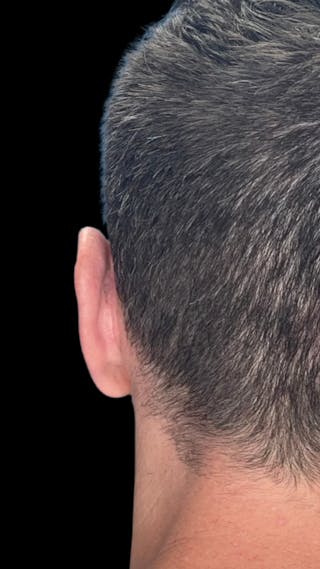 Otoplasty Before & After Gallery - Patient 215442 - Image 2