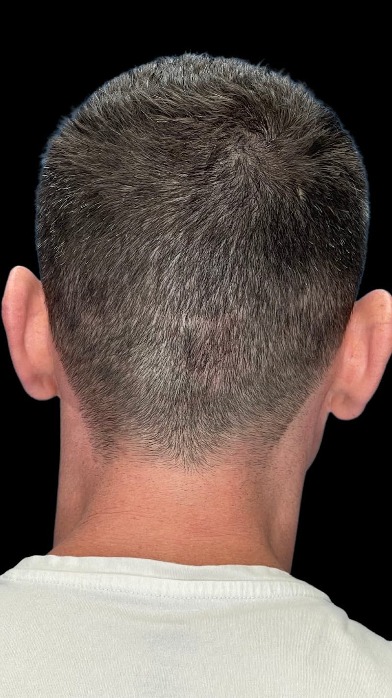 Otoplasty Before & After Gallery - Patient 215442 - Image 3