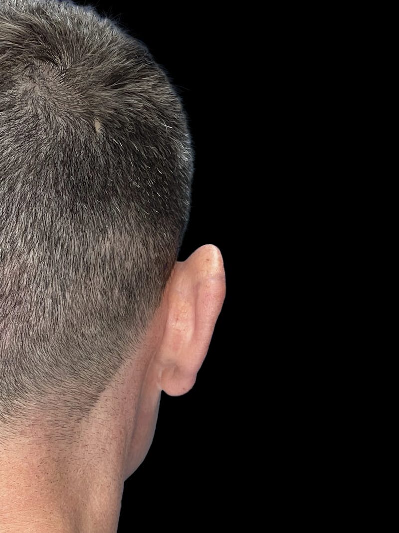 Otoplasty Before & After Gallery - Patient 215442 - Image 5