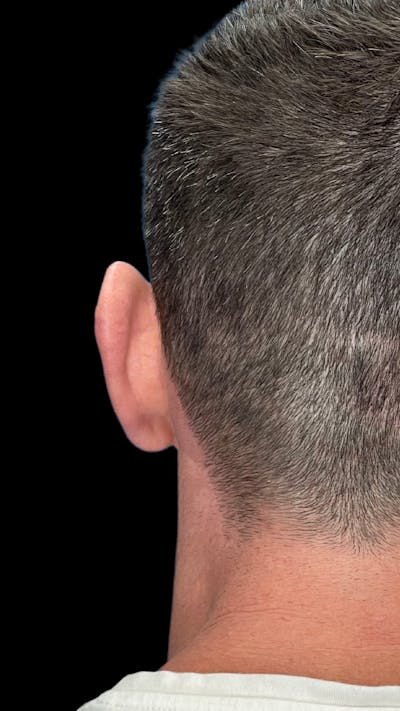 Otoplasty Before & After Gallery - Patient 215442 - Image 1