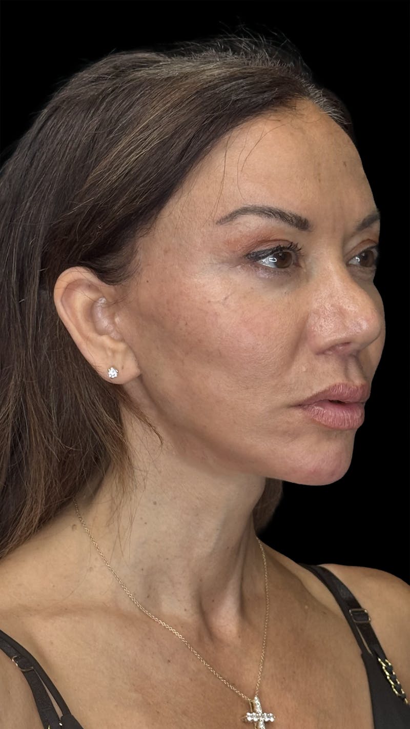 Lip Lift Before & After Gallery - Patient 189255 - Image 2