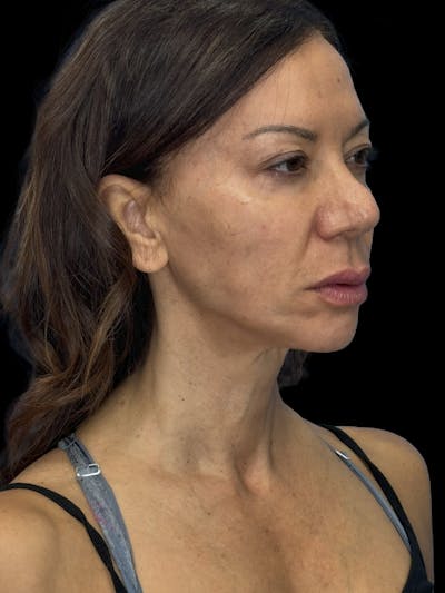Lip Lift Before & After Gallery - Patient 189255 - Image 1