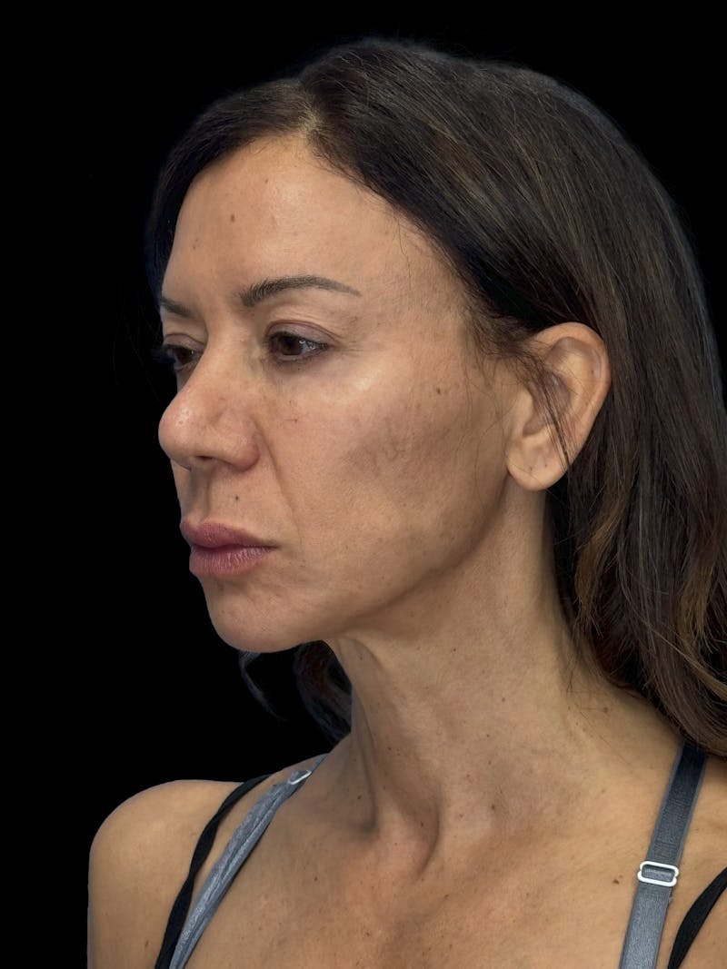 Lip Lift Before & After Gallery - Patient 189255 - Image 3