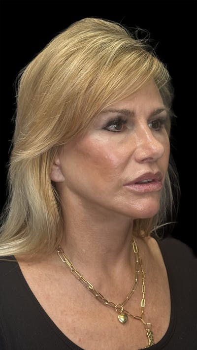 Lip Lift Before & After Gallery - Patient 256705 - Image 2