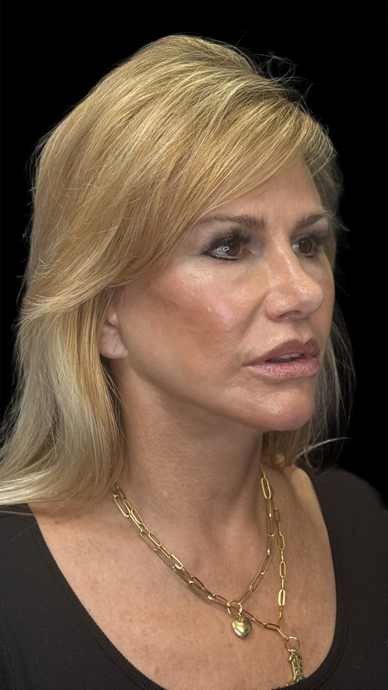 Lip Lift Before & After Gallery - Patient 256705 - Image 2