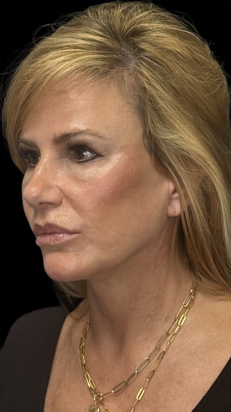 Lip Lift Before & After Gallery - Patient 256705 - Image 4