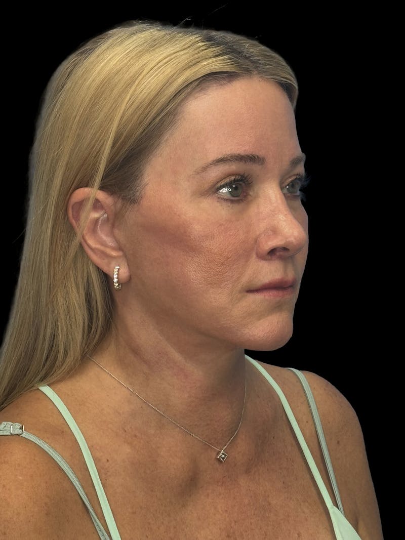 Lip Lift Before & After Gallery - Patient 344470 - Image 2