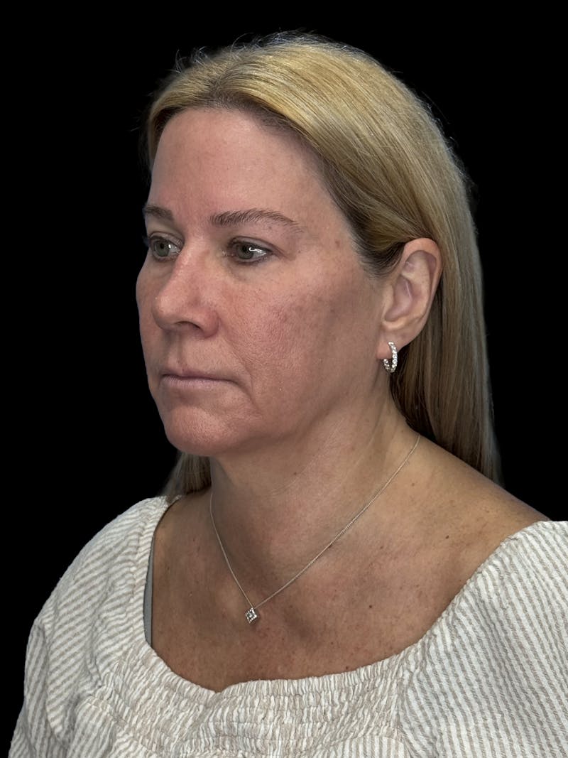 Lip Lift Before & After Gallery - Patient 344470 - Image 3