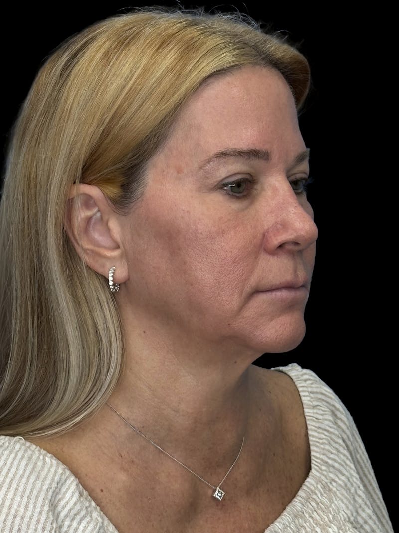 Lip Lift Before & After Gallery - Patient 344470 - Image 1