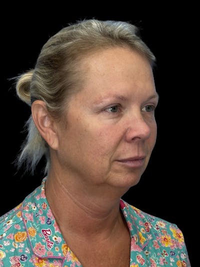 Lip Lift Before & After Gallery - Patient 613957 - Image 1