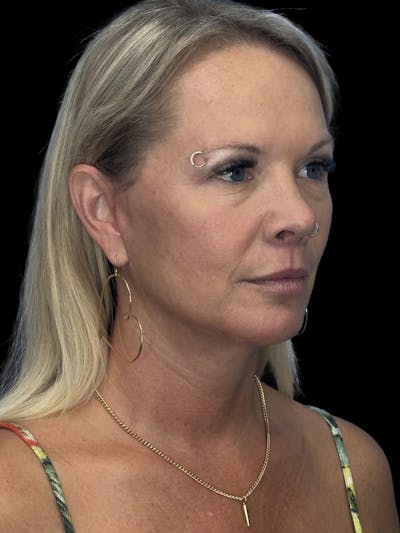 Lip Lift Before & After Gallery - Patient 613957 - Image 2