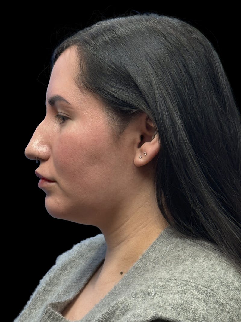 Neck Liposuction Before & After Gallery - Patient 320592 - Image 6
