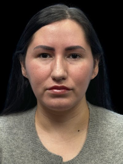 Neck Liposuction Before & After Gallery - Patient 320592 - Image 2