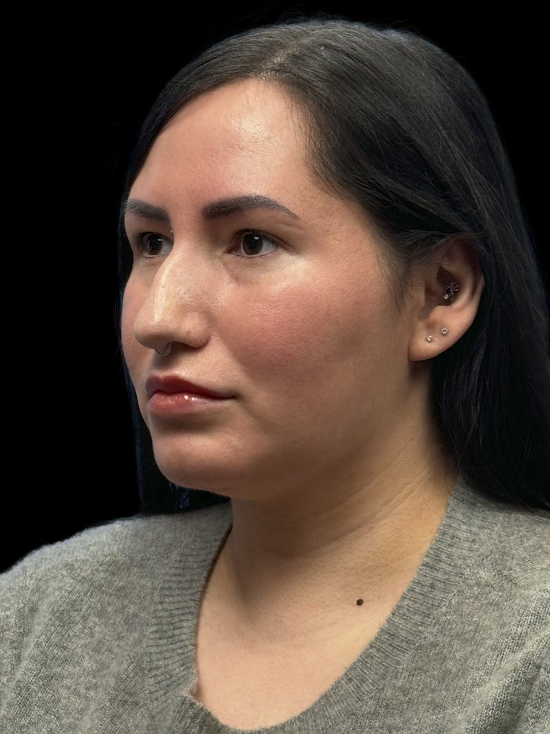 Neck Liposuction Before & After Gallery - Patient 320592 - Image 4