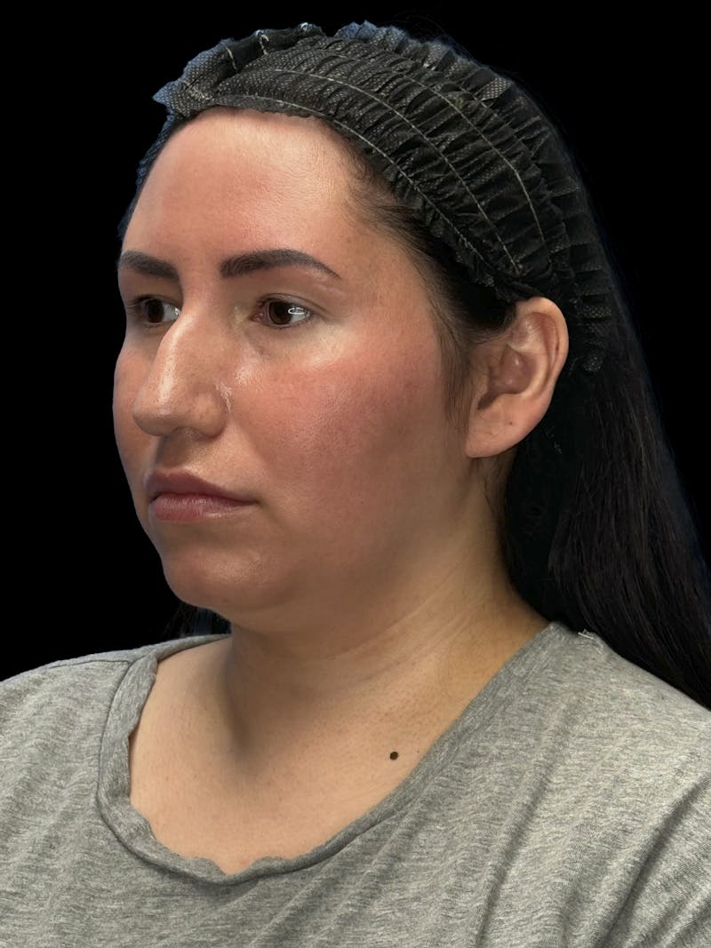 Neck Liposuction Before & After Gallery - Patient 320592 - Image 3