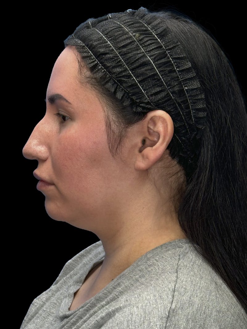 Neck Liposuction Before & After Gallery - Patient 320592 - Image 5