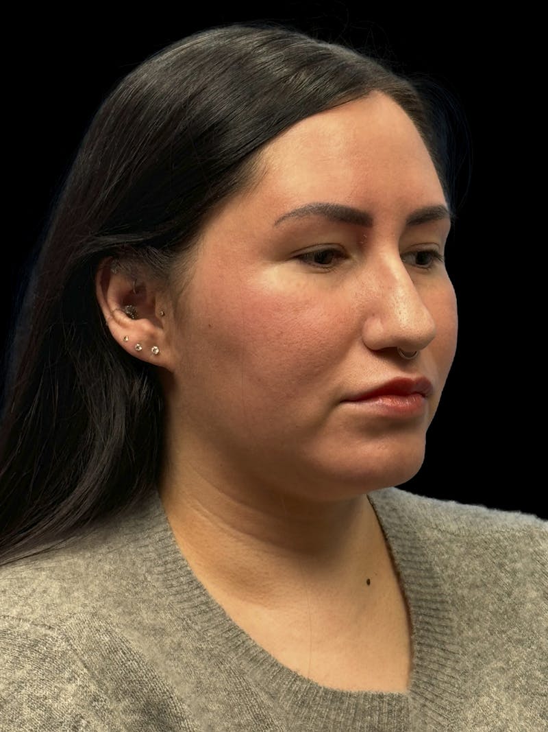Neck Liposuction Before & After Gallery - Patient 320592 - Image 8