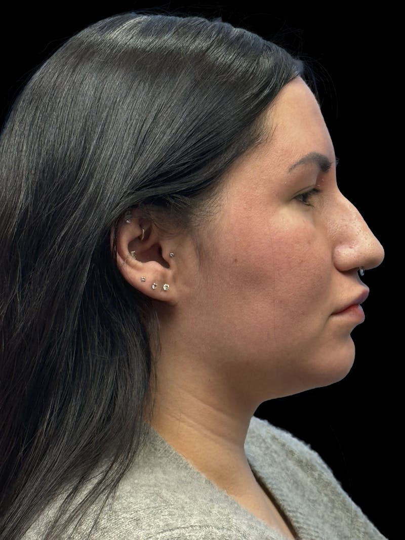 Neck Liposuction Before & After Gallery - Patient 320592 - Image 10