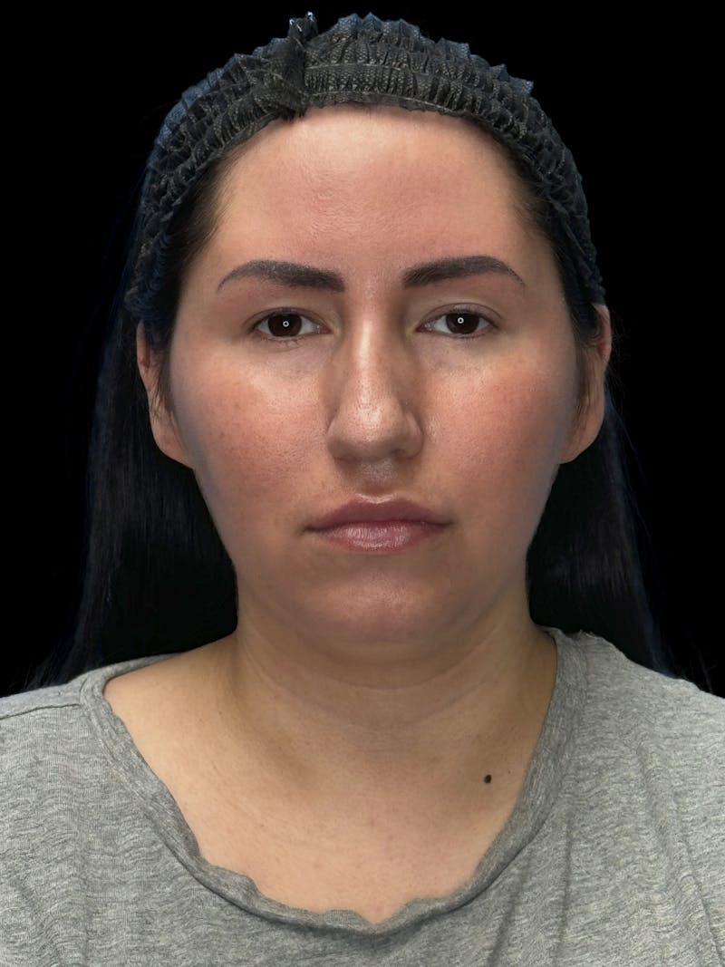 Neck Liposuction Before & After Gallery - Patient 320592 - Image 1