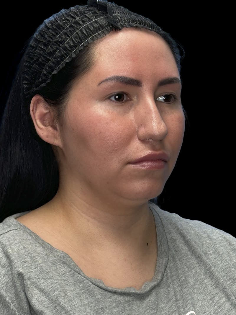 Neck Liposuction Before & After Gallery - Patient 320592 - Image 7