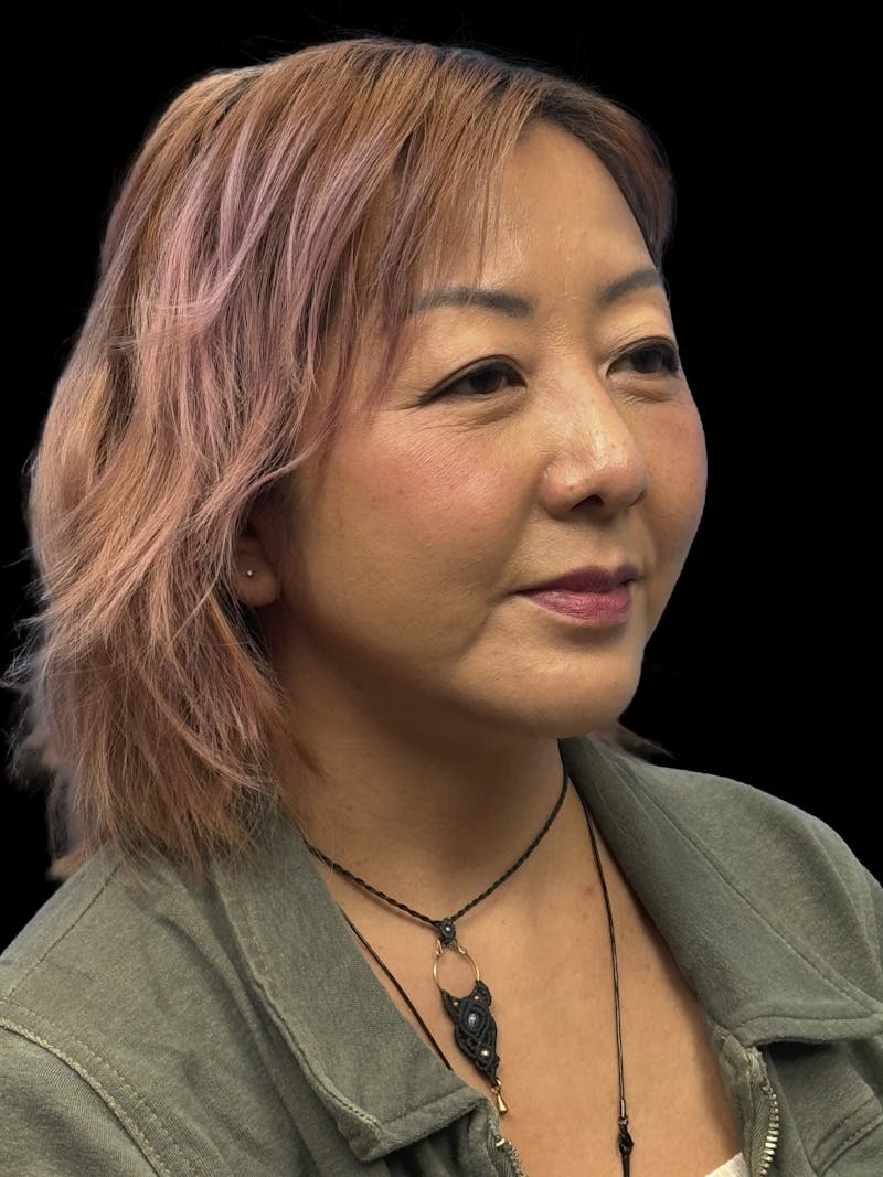 Neck Lift Before & After Gallery - Patient 146863 - Image 6