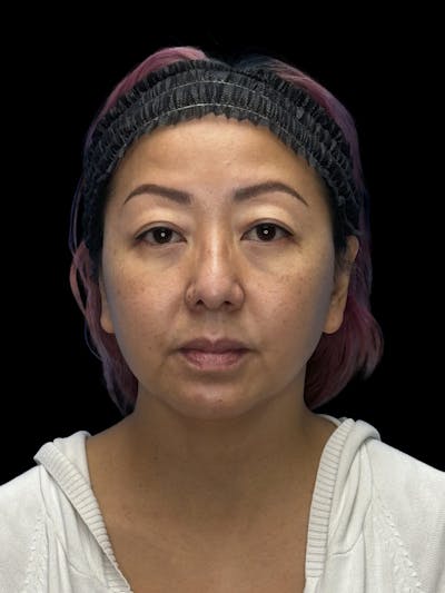 Neck Lift Before & After Gallery - Patient 146863 - Image 1
