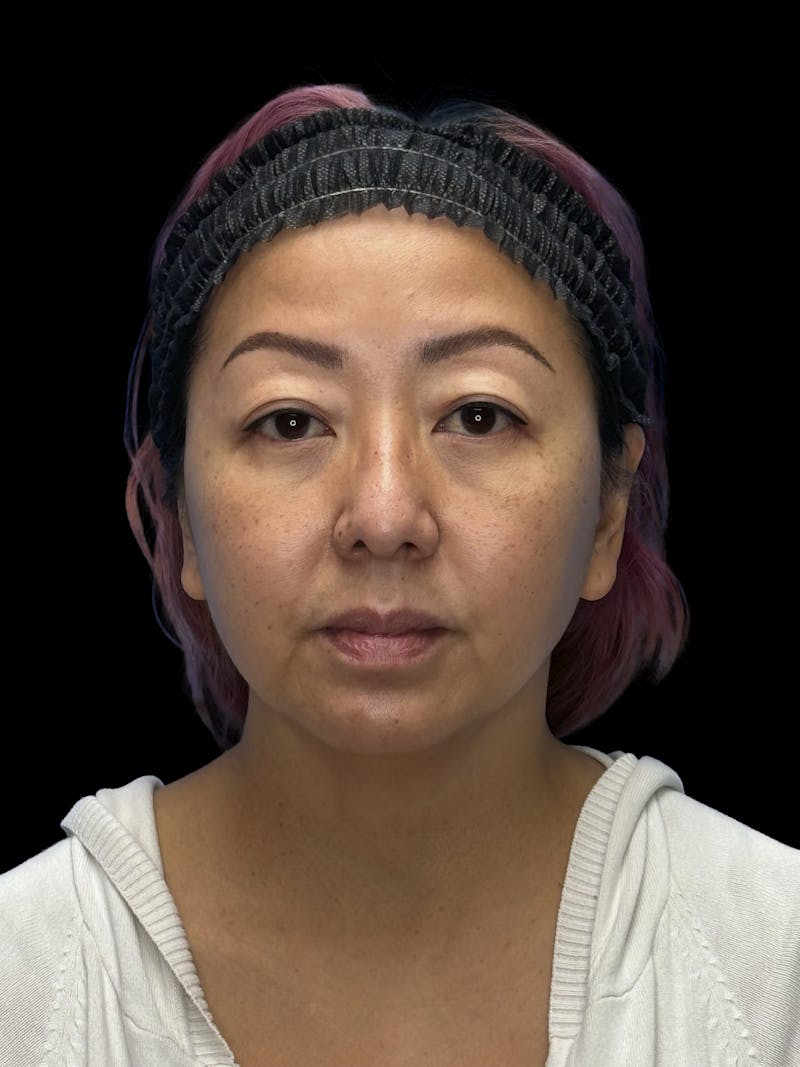 Neck Lift Before & After Gallery - Patient 146863 - Image 1