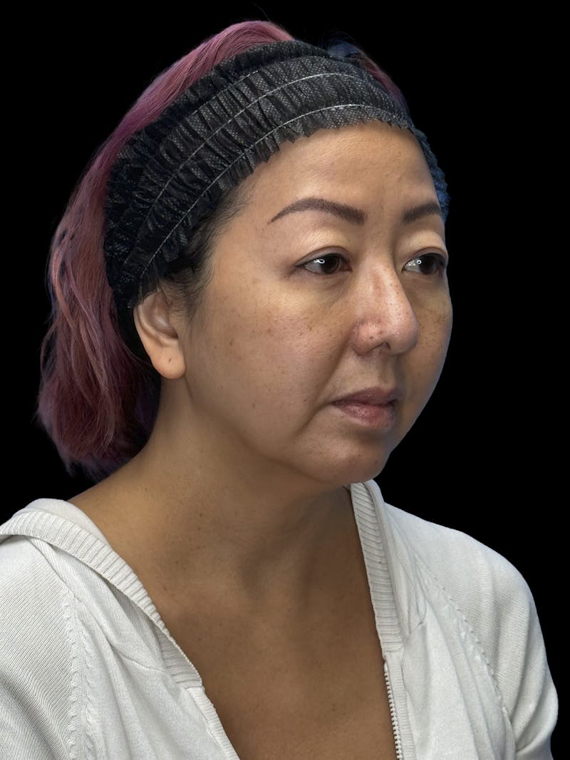 Neck Lift Before & After Gallery - Patient 146863 - Image 5