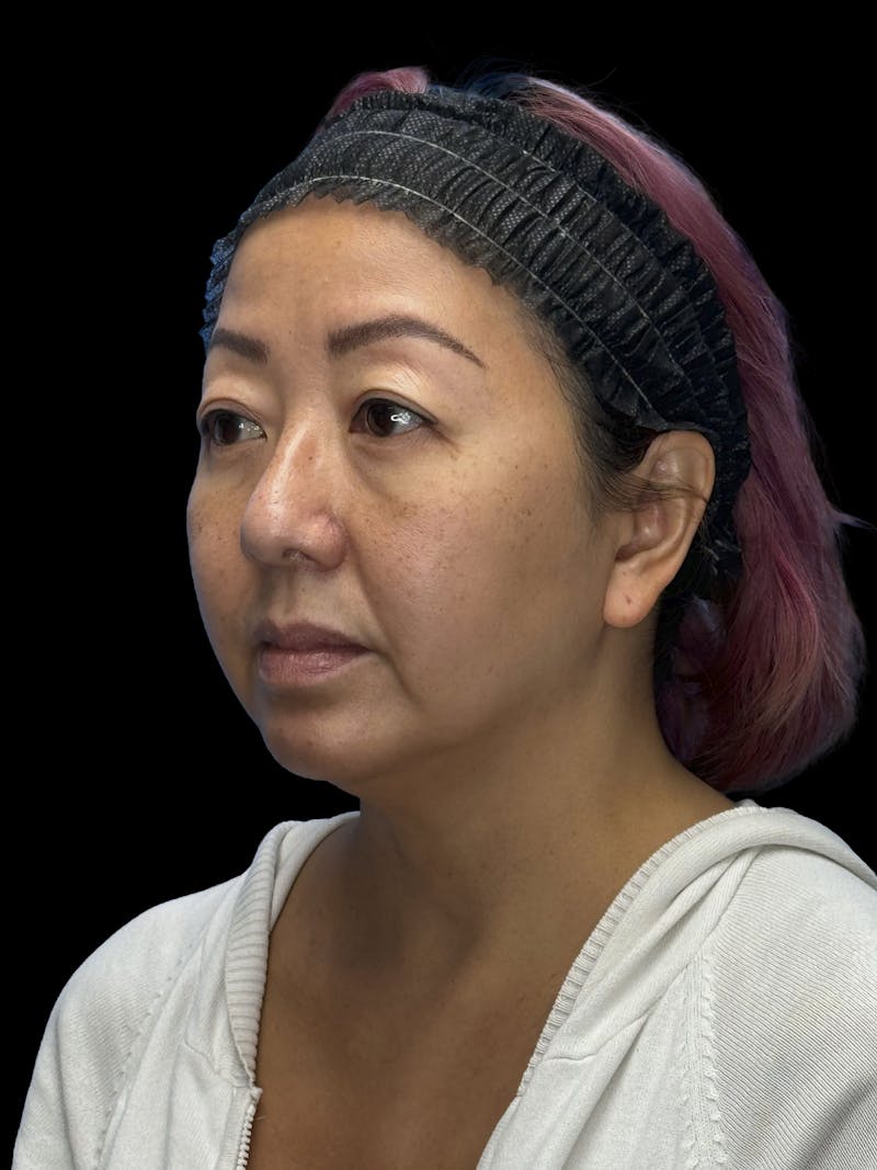 Neck Lift Before & After Gallery - Patient 146863 - Image 3
