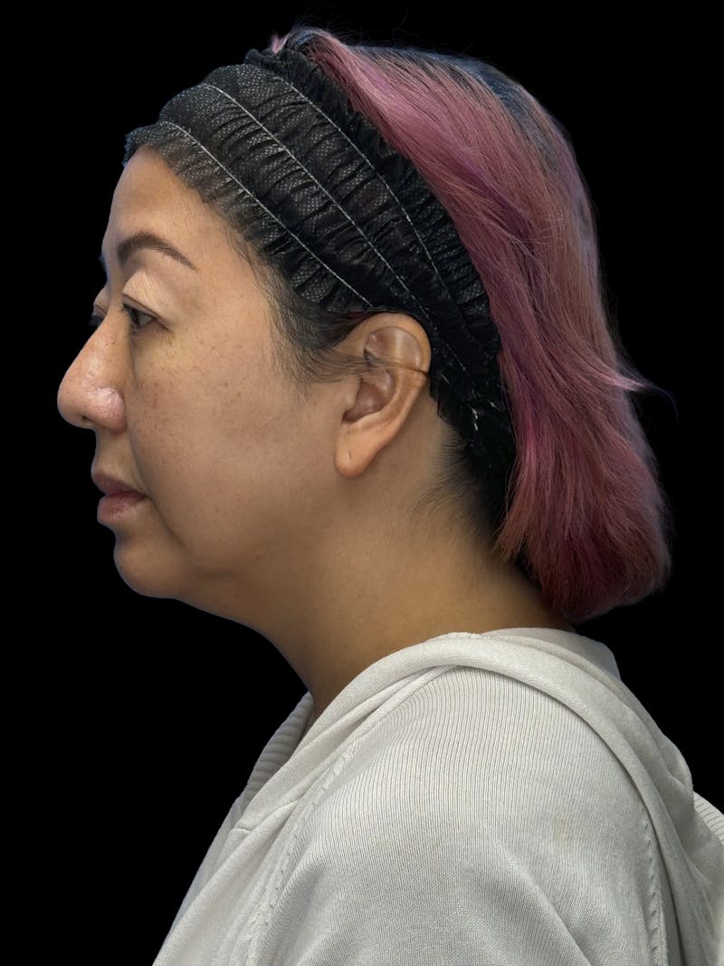 Neck Lift Before & After Gallery - Patient 146863 - Image 7
