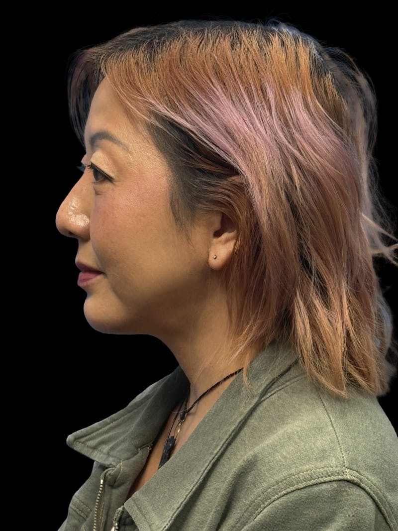 Neck Lift Before & After Gallery - Patient 146863 - Image 8
