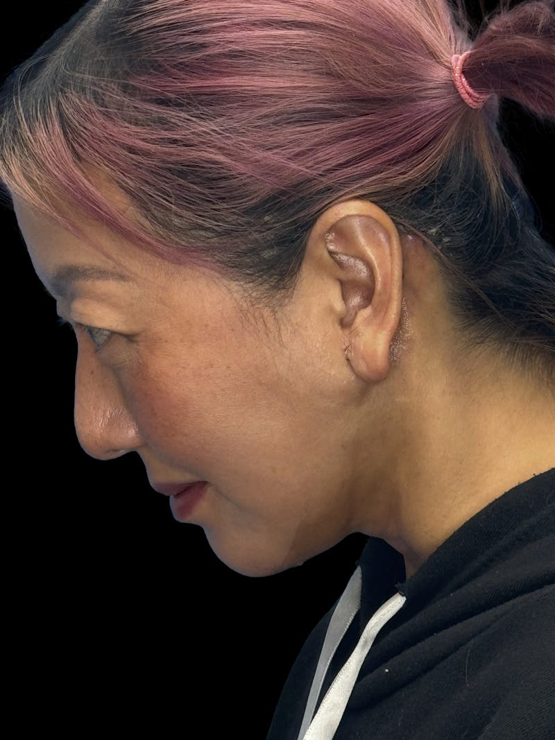 Neck Lift Before & After Gallery - Patient 146863 - Image 10