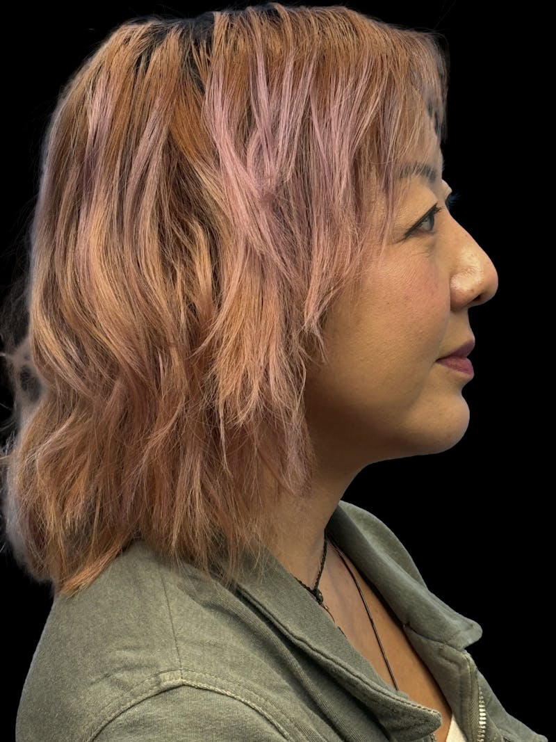 Neck Lift Before & After Gallery - Patient 146863 - Image 12