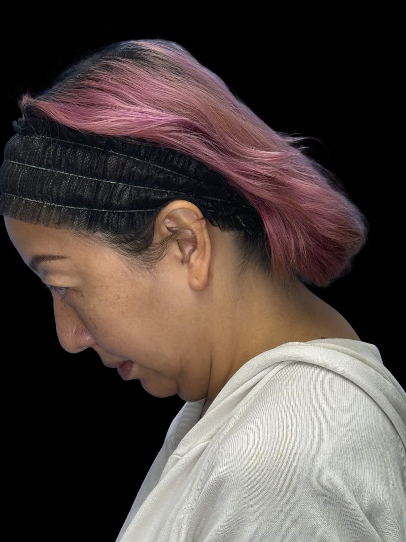 Neck Lift Before & After Gallery - Patient 146863 - Image 9