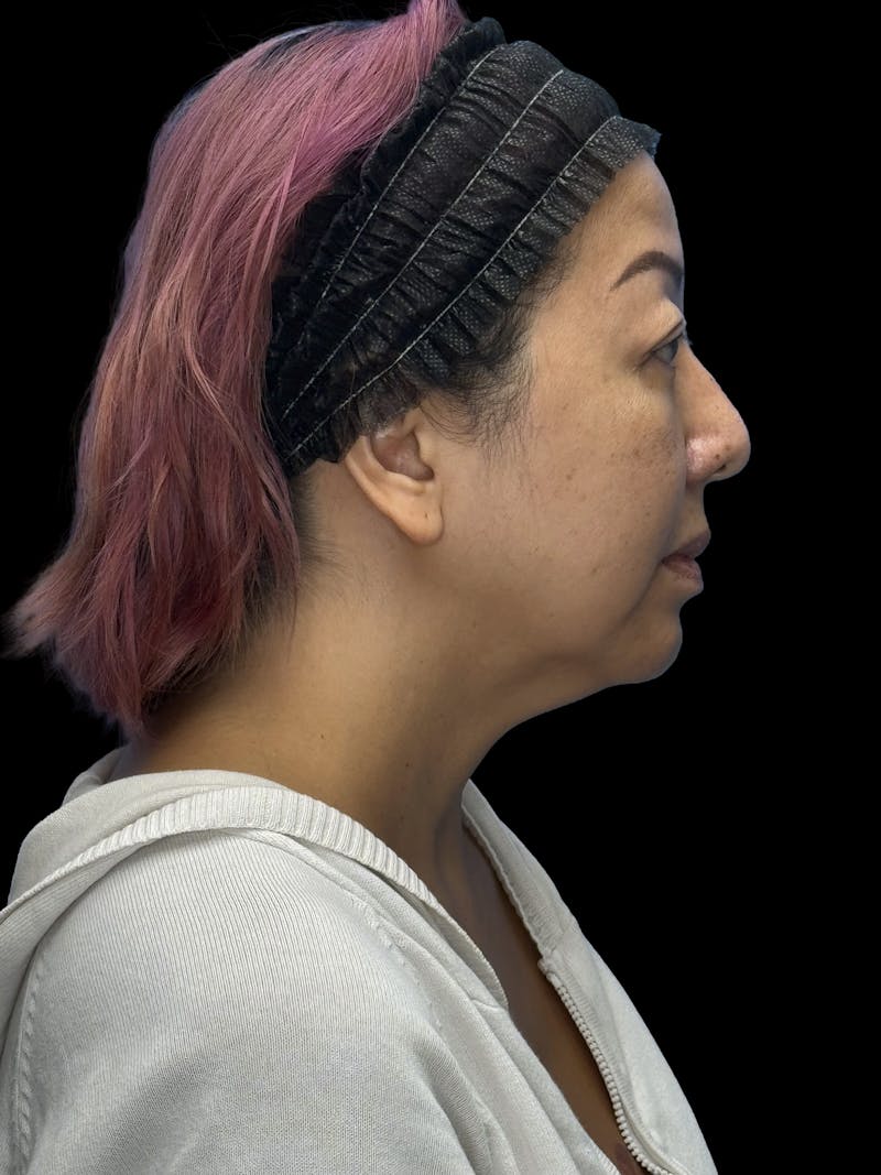 Neck Lift Before & After Gallery - Patient 146863 - Image 11