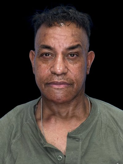 Neck Lift Before & After Gallery - Patient 129204 - Image 2