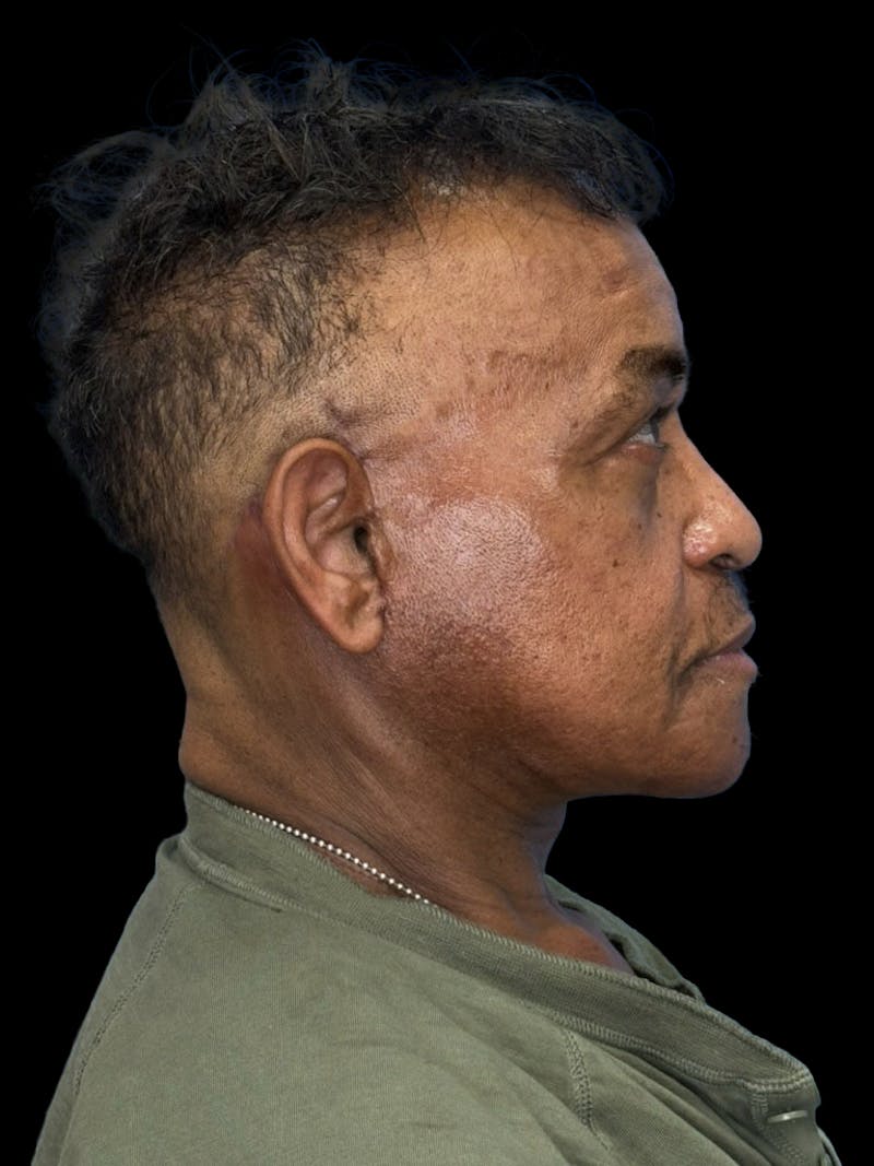Neck Lift Before & After Gallery - Patient 129204 - Image 4
