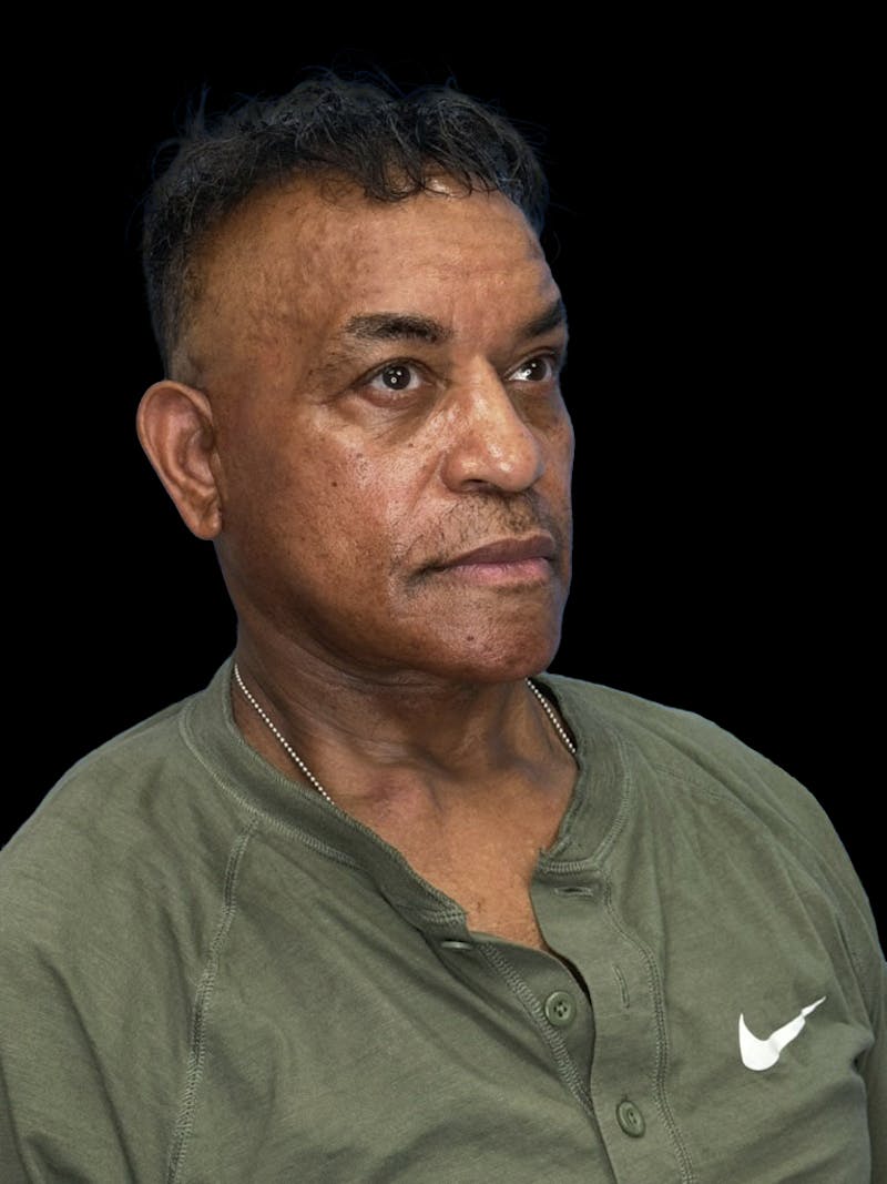 Neck Lift Before & After Gallery - Patient 129204 - Image 7