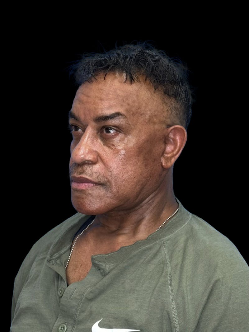 Neck Lift Before & After Gallery - Patient 129204 - Image 6