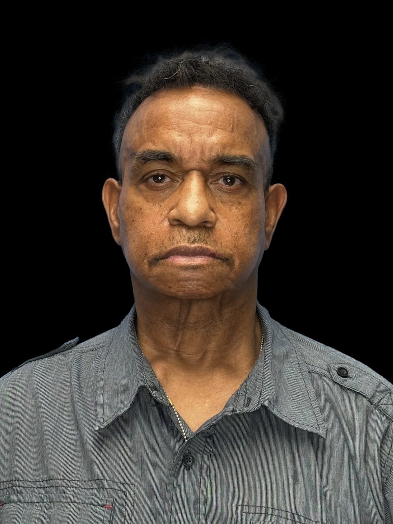 Neck Lift Before & After Gallery - Patient 129204 - Image 1