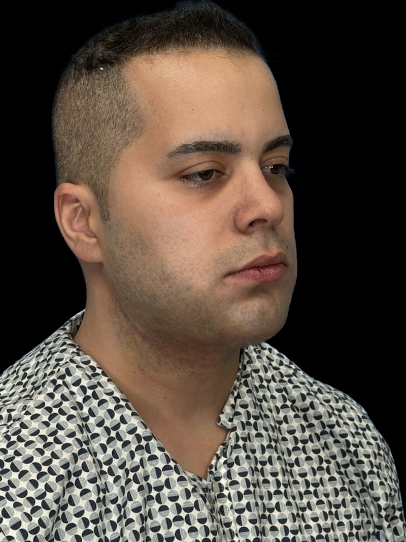 Neck Lift Before & After Gallery - Patient 360884 - Image 10