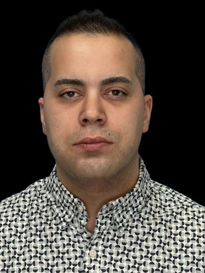Neck Lift Before & After Gallery - Patient 360884 - Image 2